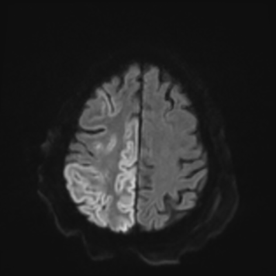 MRI brain (DWI) 18/24