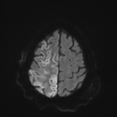 MRI brain (DWI) 19/24