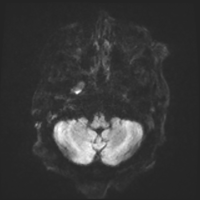 MRI brain (DWI) 2/24