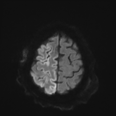 MRI brain (DWI) 20/24