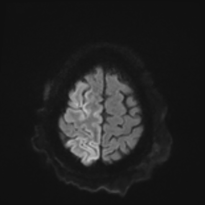 MRI brain (DWI) 21/24