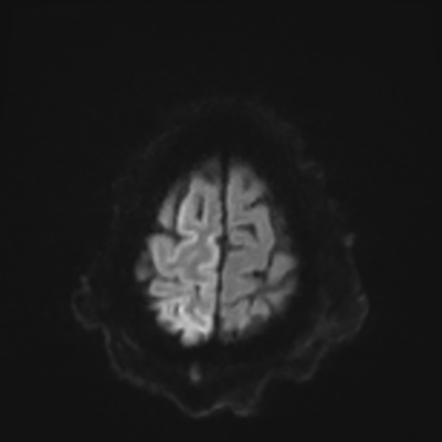 MRI brain (DWI) 22/24