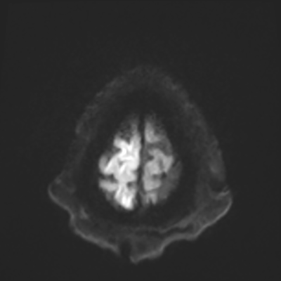 MRI brain (DWI) 23/24