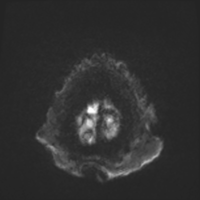 MRI brain (DWI) 24/24