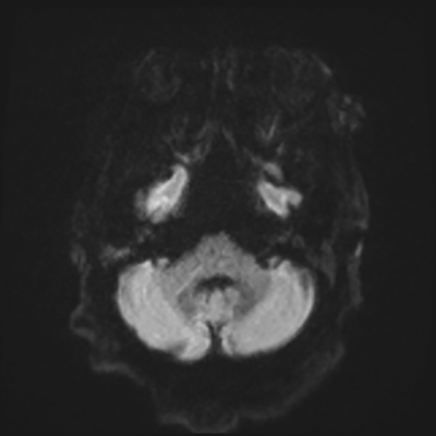 MRI brain (DWI) 3/24