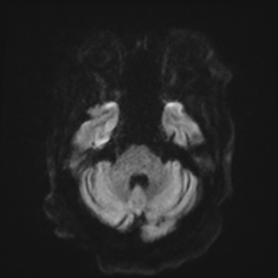 MRI brain (DWI) 4/24