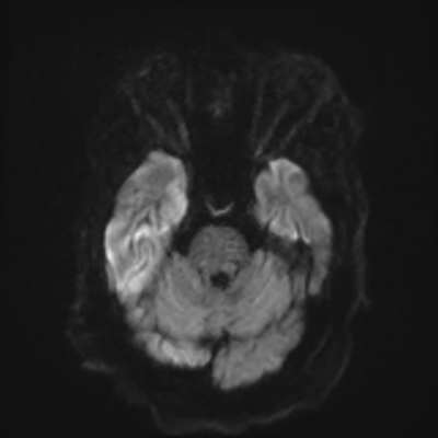 MRI brain (DWI) 5/24