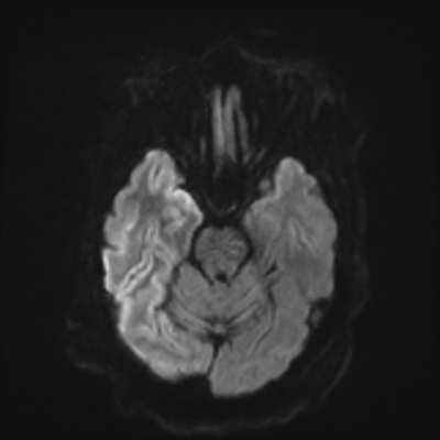 MRI brain (DWI) 6/24