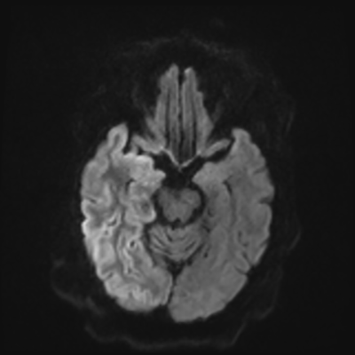 MRI brain (DWI) 7/24