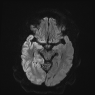 MRI brain (DWI) 8/24