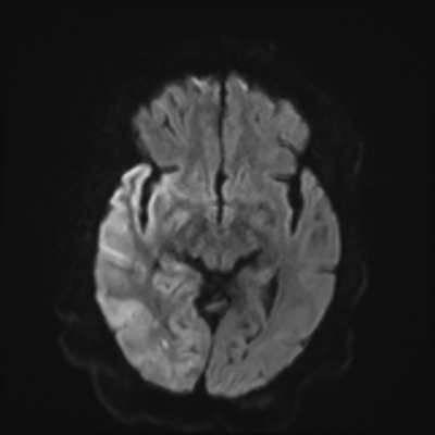 MRI brain (DWI) 9/24