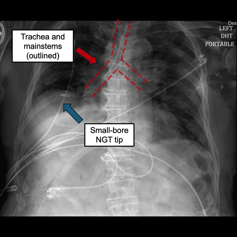 Annotated chest X-ray with NGT placed